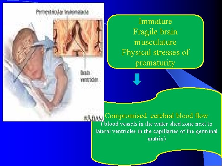 Immature Fragile brain musculature Physical stresses of prematurity Compromised cerebral blood flow ( blood