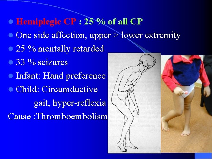 l Hemiplegic CP : 25 % of all CP l One side affection, upper