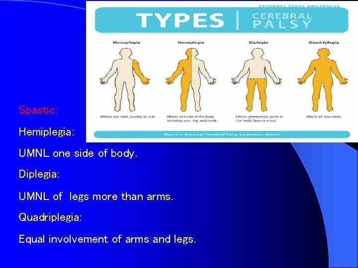 Spastic: Hemiplegia: UMNL one side of body. Diplegia: UMNL of legs more than arms.