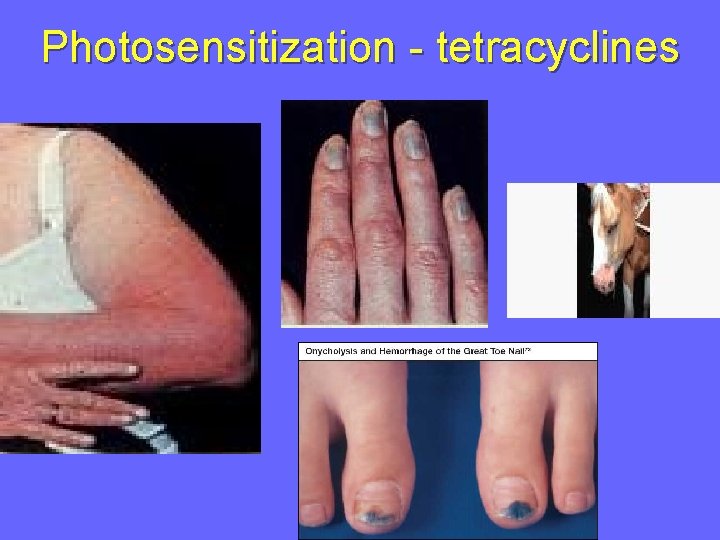 Photosensitization - tetracyclines 