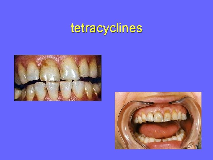 tetracyclines 