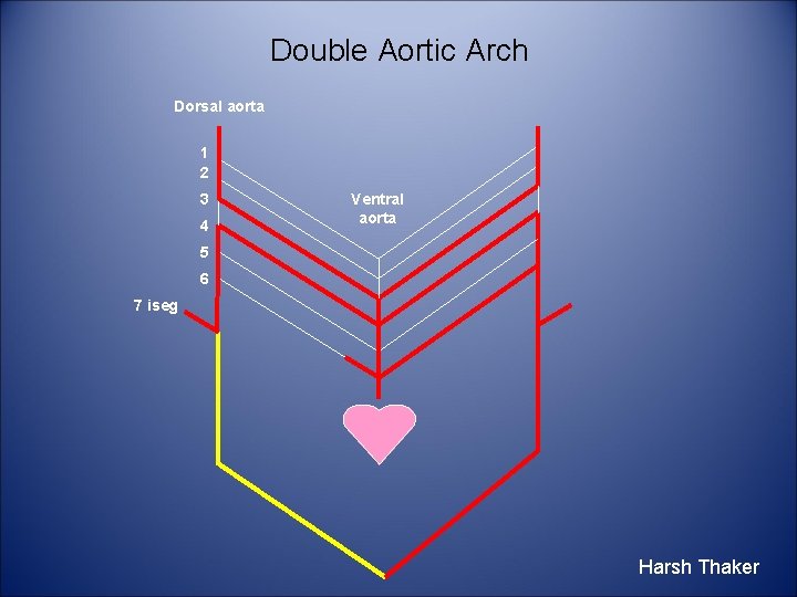 Double Aortic Arch Dorsal aorta 1 2 3 4 Ventral aorta 5 6 7