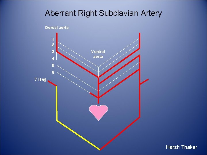 Aberrant Right Subclavian Artery Dorsal aorta 1 2 3 4 Ventral aorta 5 6