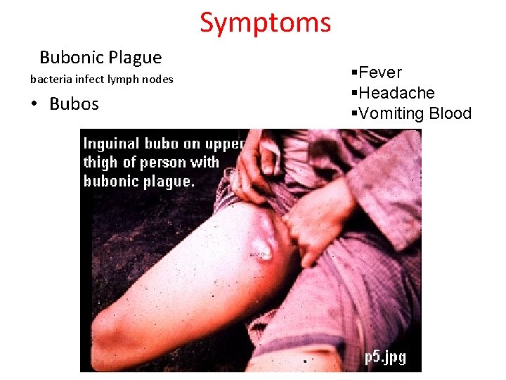 Symptoms Bubonic Plague bacteria infect lymph nodes • Bubos §Fever §Headache §Vomiting Blood 