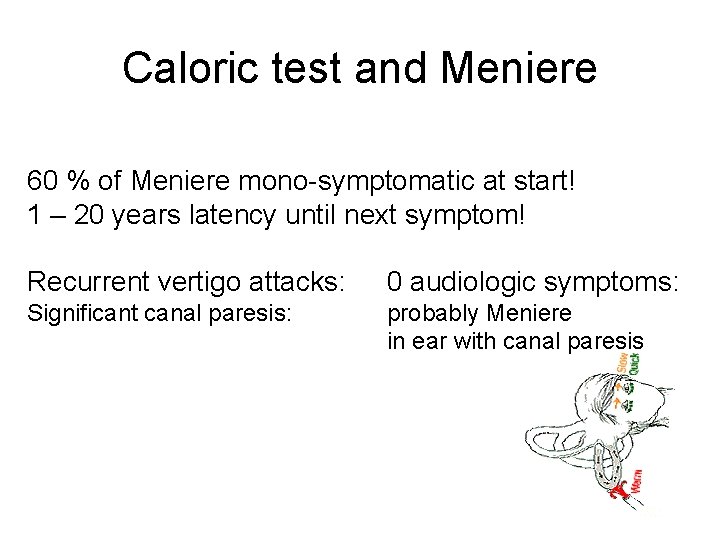 Caloric test and Meniere 60 % of Meniere mono-symptomatic at start! 1 – 20