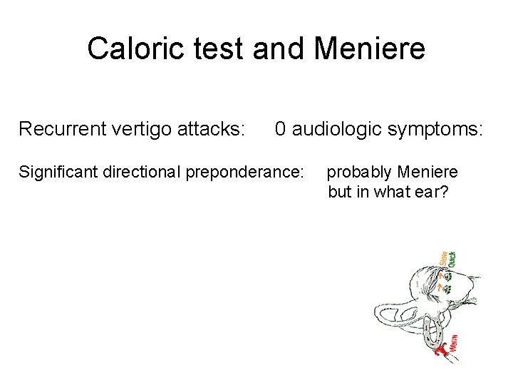 Caloric test and Meniere Recurrent vertigo attacks: 0 audiologic symptoms: Significant directional preponderance: probably