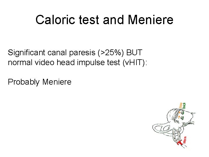 Caloric test and Meniere Significant canal paresis (>25%) BUT normal video head impulse test