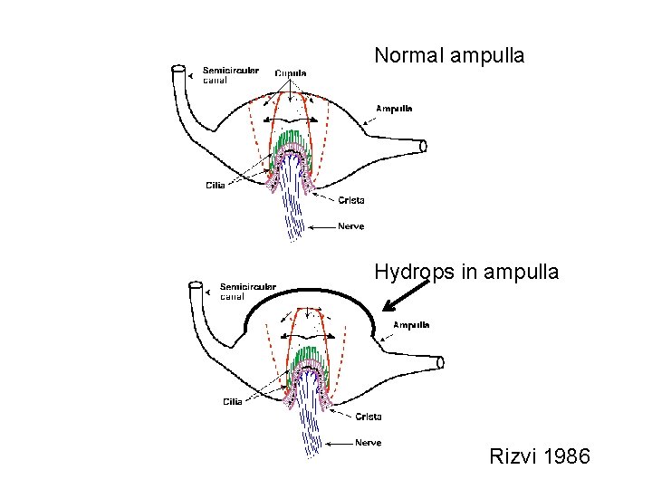 Normal ampulla Hydrops in ampulla Rizvi 1986 