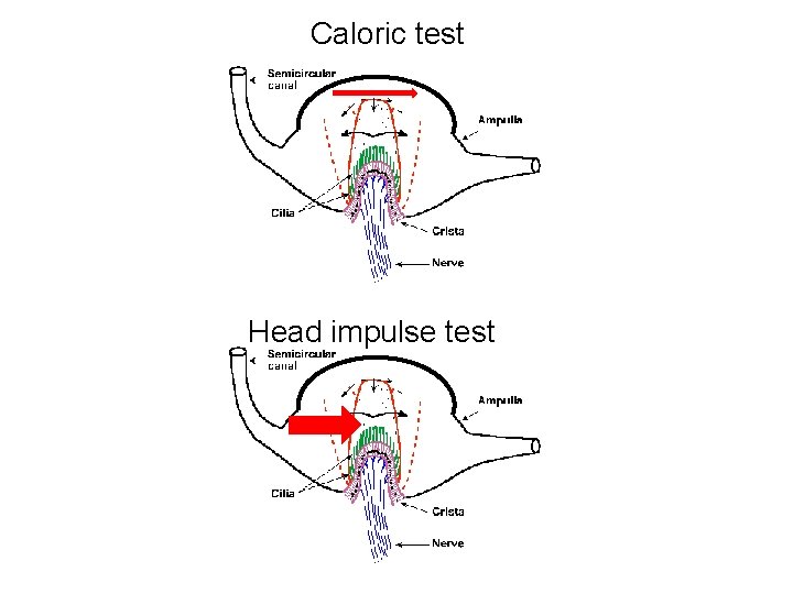 Caloric test Head impulse test 