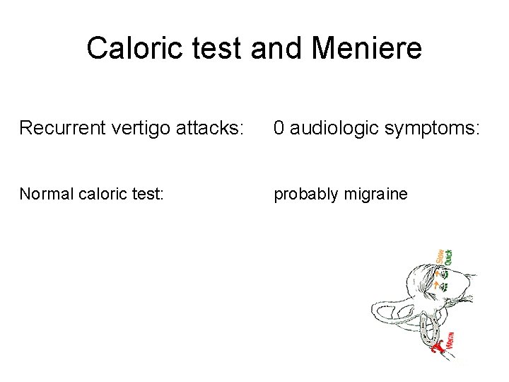 Caloric test and Meniere Recurrent vertigo attacks: 0 audiologic symptoms: Normal caloric test: probably