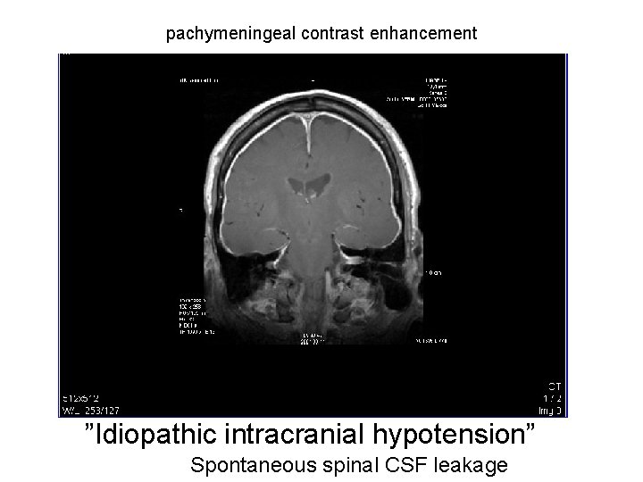 pachymeningeal contrast enhancement ”Idiopathic intracranial hypotension” Spontaneous spinal CSF leakage 