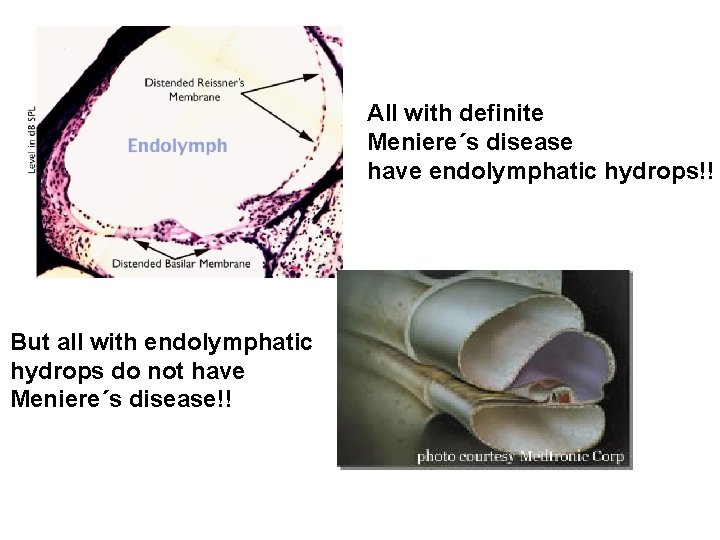 All with definite Meniere´s disease have endolymphatic hydrops!! But all with endolymphatic hydrops do