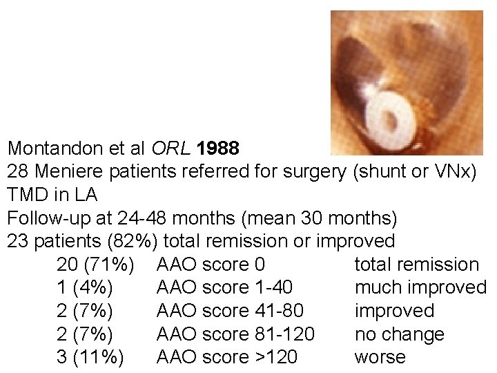 Montandon et al ORL 1988 28 Meniere patients referred for surgery (shunt or VNx)