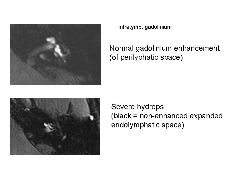 intratymp. gadolinium Normal gadolinium enhancement (of perilyphatic space) Severe hydrops (black = non-enhanced expanded