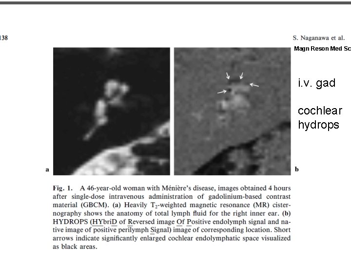 Naganawa S et al 2013 Magn Reson Med Sc i. v. gad cochlear hydrops