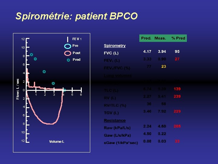 Spirométrie: patient BPCO FEV 1 12 Pre 10 Post 8 Pred 6 Flow :