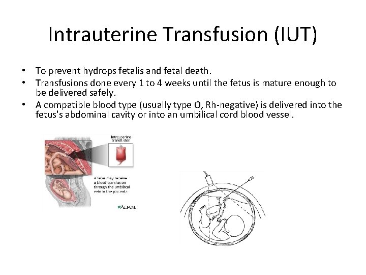 Intrauterine Transfusion (IUT) • To prevent hydrops fetalis and fetal death. • Transfusions done