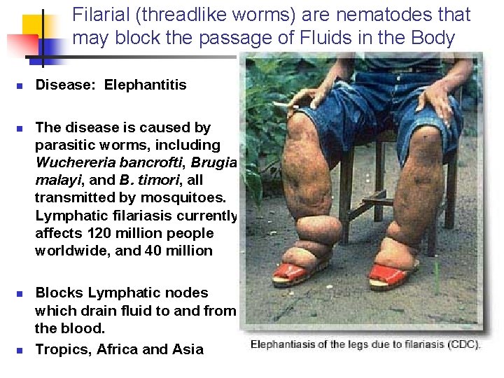 Filarial (threadlike worms) are nematodes that may block the passage of Fluids in the