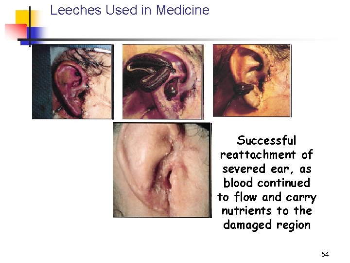 Leeches Used in Medicine Successful reattachment of severed ear, as blood continued to flow