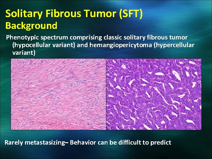 Solitary Fibrous Tumor (SFT) Background Phenotypic spectrum comprising classic solitary fibrous tumor (hypocellular variant)