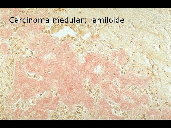 Carcinoma medular: amiloide 