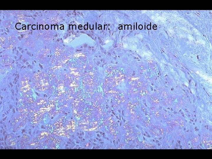 Carcinoma medular: amiloide 