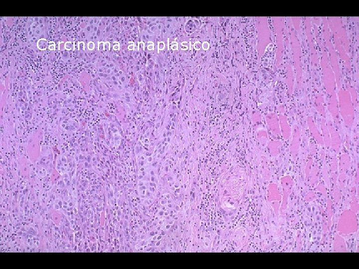Carcinoma anaplásico 