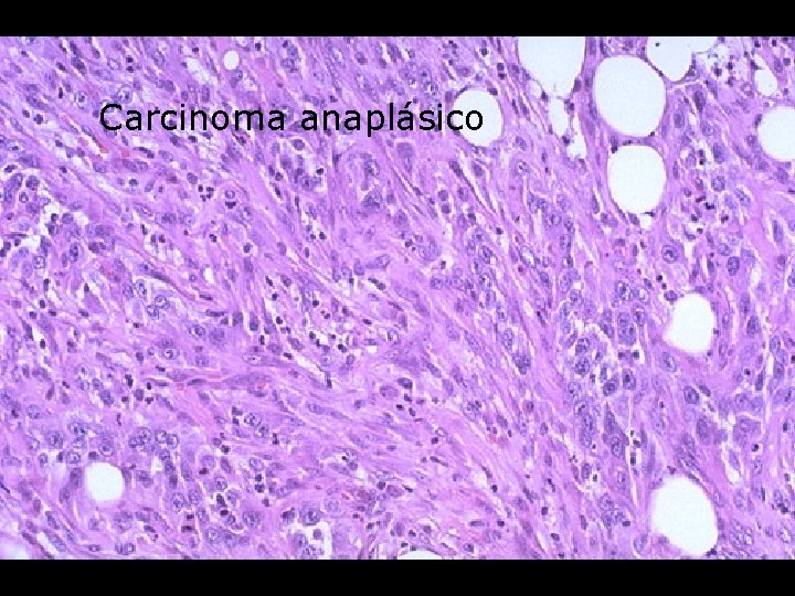 Carcinoma anaplásico 