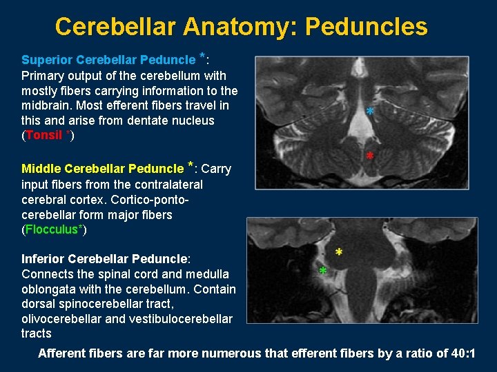 Cerebellar Anatomy: Peduncles Superior Cerebellar Peduncle *: Primary output of the cerebellum with mostly