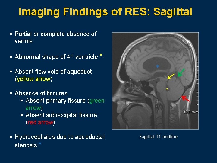 Imaging Findings of RES: Sagittal § Partial or complete absence of vermis § Abnormal