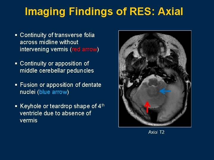 Imaging Findings of RES: Axial § Continuity of transverse folia across midline without intervening