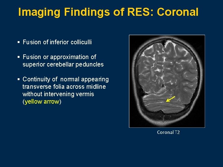 Imaging Findings of RES: Coronal § Fusion of inferior colliculli § Fusion or approximation