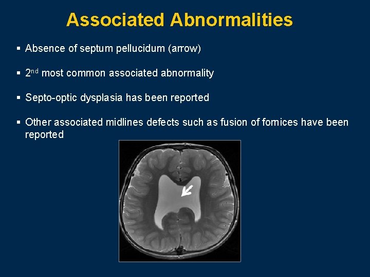 Associated Abnormalities § Absence of septum pellucidum (arrow) § 2 nd most common associated