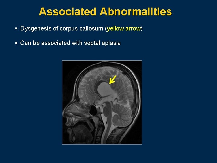 Associated Abnormalities § Dysgenesis of corpus callosum (yellow arrow) § Can be associated with