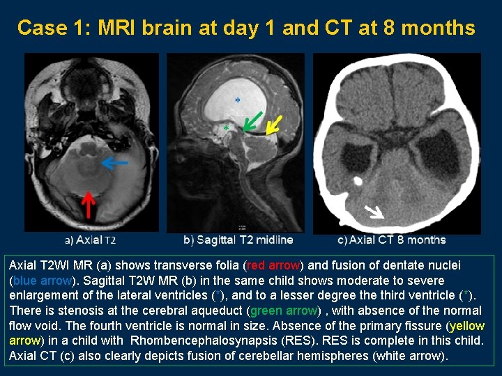 Case 1: MRI brain at day 1 and CT at 8 months Axial T