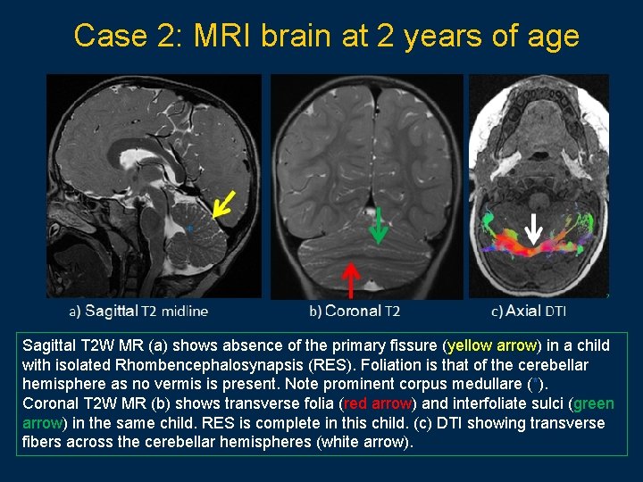 Case 2: MRI brain at 2 years of age Sagittal T 2 W MR