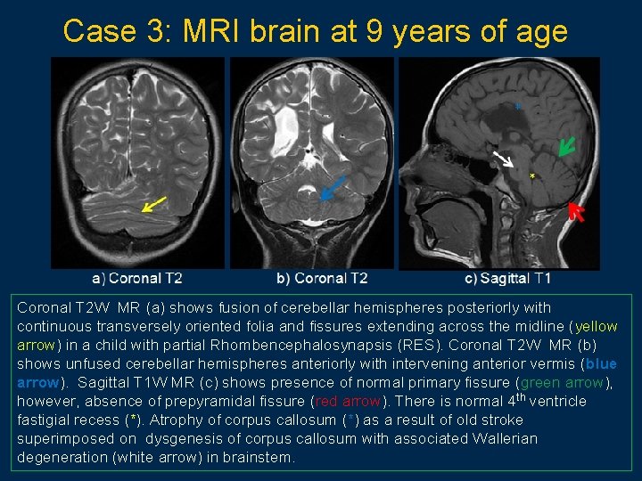 Case 3: MRI brain at 9 years of age Coronal T 2 W MR