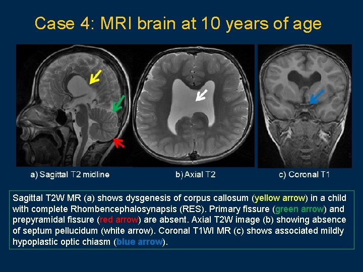 Case 4: MRI brain at 10 years of age Sagittal T 2 W MR