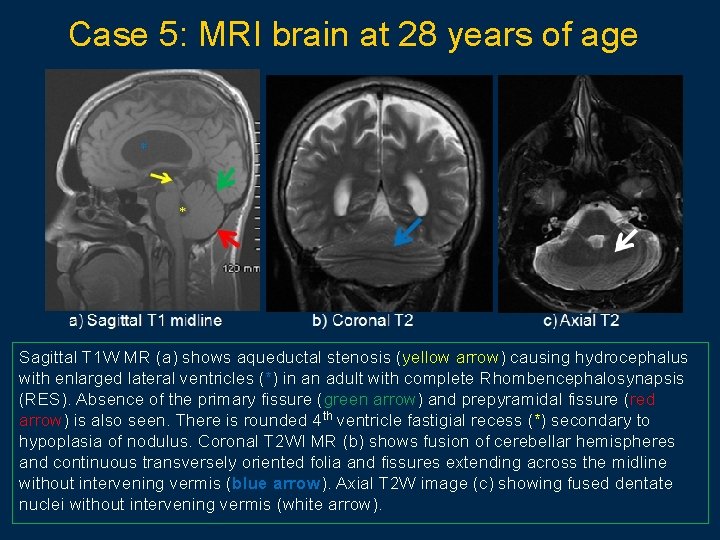 Case 5: MRI brain at 28 years of age Sagittal T 1 W MR