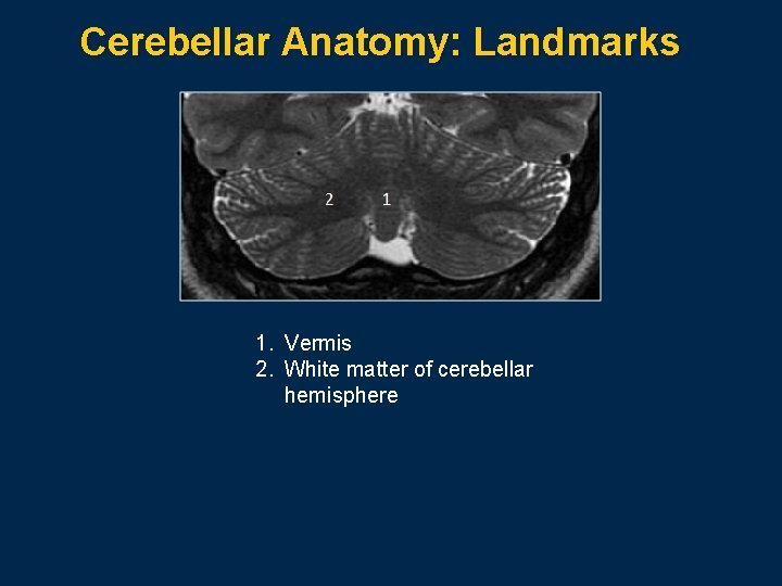 Cerebellar Anatomy: Landmarks 1. Vermis 2. White matter of cerebellar hemisphere 
