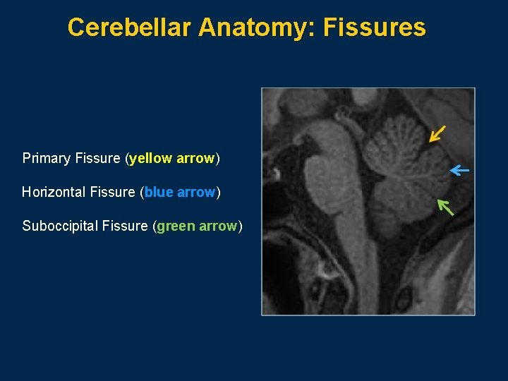Cerebellar Anatomy: Fissures Primary Fissure (yellow arrow) Horizontal Fissure (blue arrow) Suboccipital Fissure (green