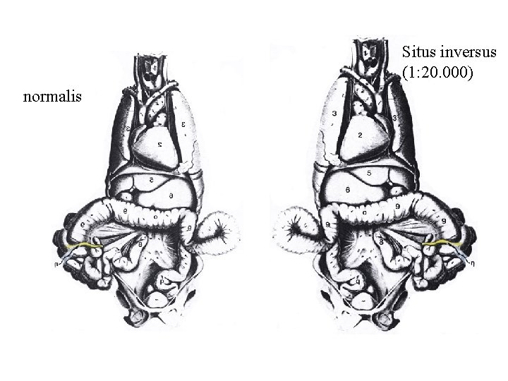 Situs inversus (1: 20. 000) normalis 