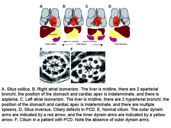 A, Situs solitus. B, Right atrial isomerism. The liver is midline, there are 2