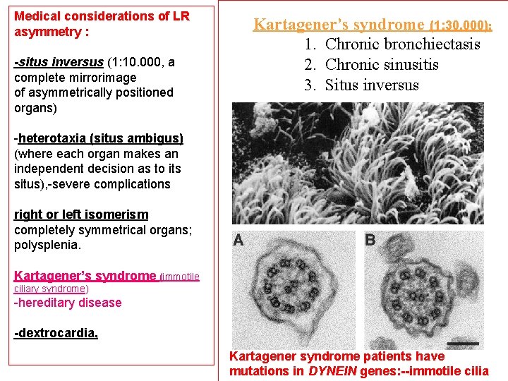 Medical considerations of LR asymmetry : -situs inversus (1: 10. 000, a complete mirrorimage