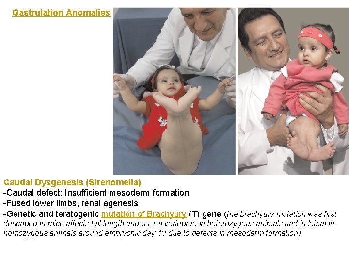 Gastrulation Anomalies Caudal Dysgenesis (Sirenomelia) -Caudal defect: Insufficient mesoderm formation -Fused lower limbs, renal