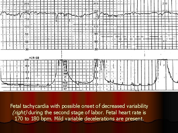 Fetal tachycardia with possible onset of decreased variability (right) during the second stage of