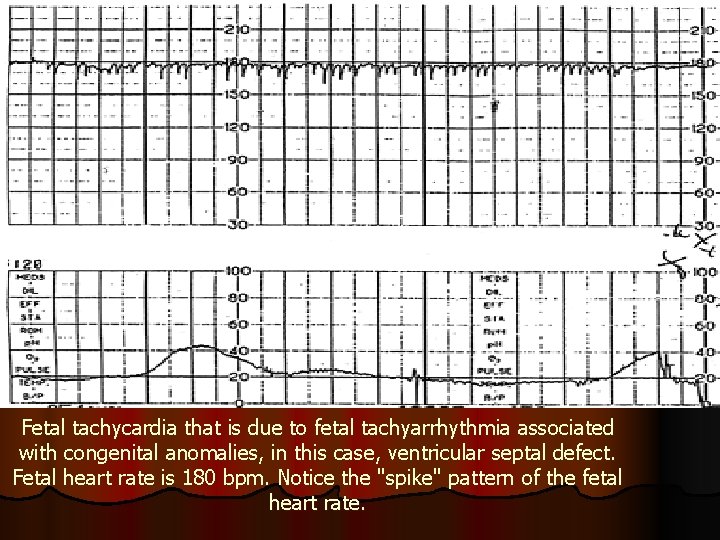 Fetal tachycardia that is due to fetal tachyarrhythmia associated with congenital anomalies, in this