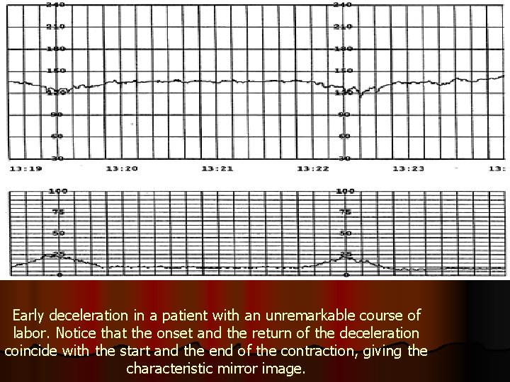 Early deceleration in a patient with an unremarkable course of labor. Notice that the