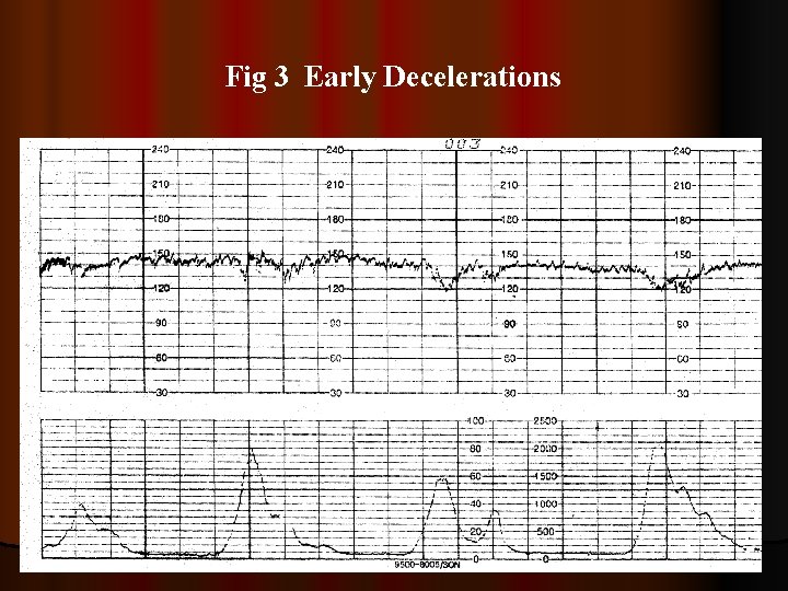 Fig 3 Early Decelerations 