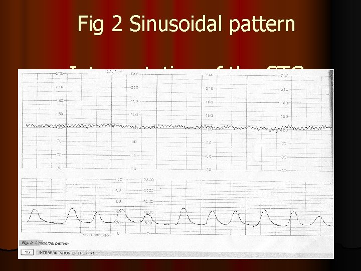 Fig 2 Sinusoidal pattern Interpretation of the CTG 